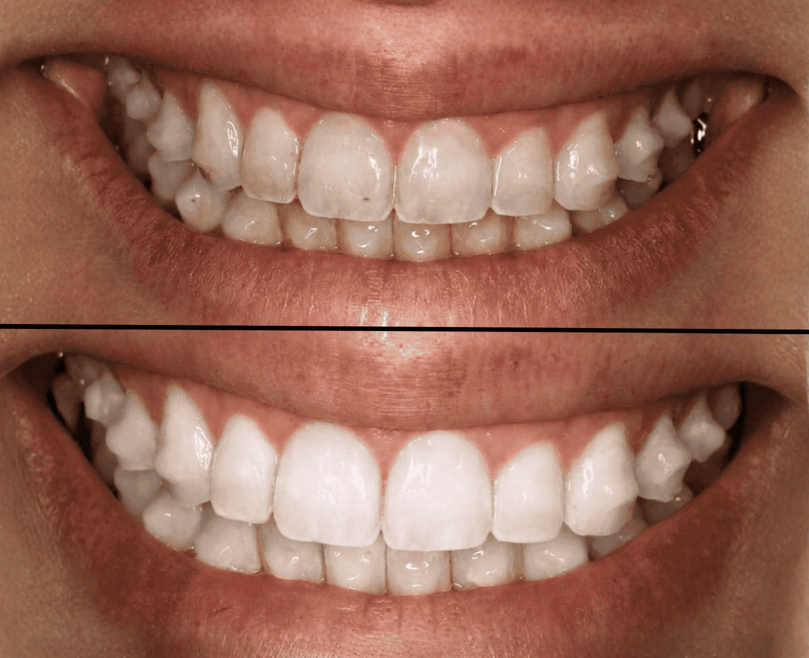 Antes e depois de clareamento dental realizado em Florianópolis pela Dra. Gabriela Newton