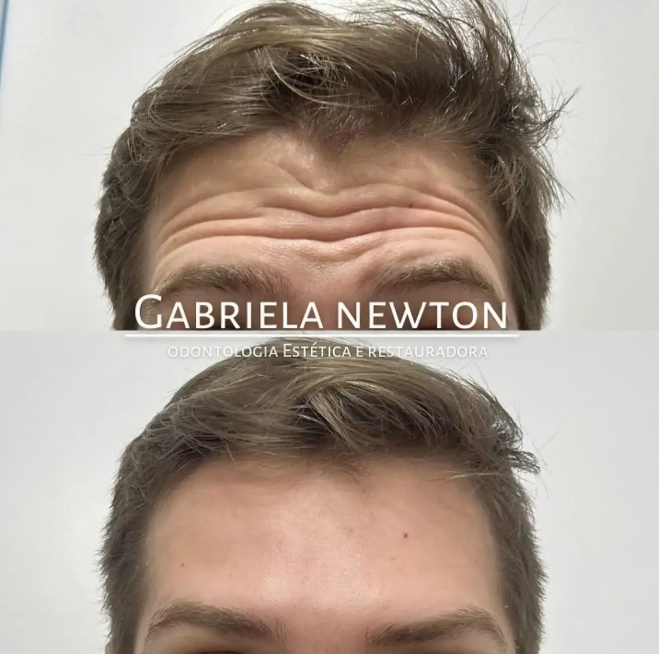 Harmonização facial com naturalidade e segurança pela Dra. Gabriela Newton em Florianópolis