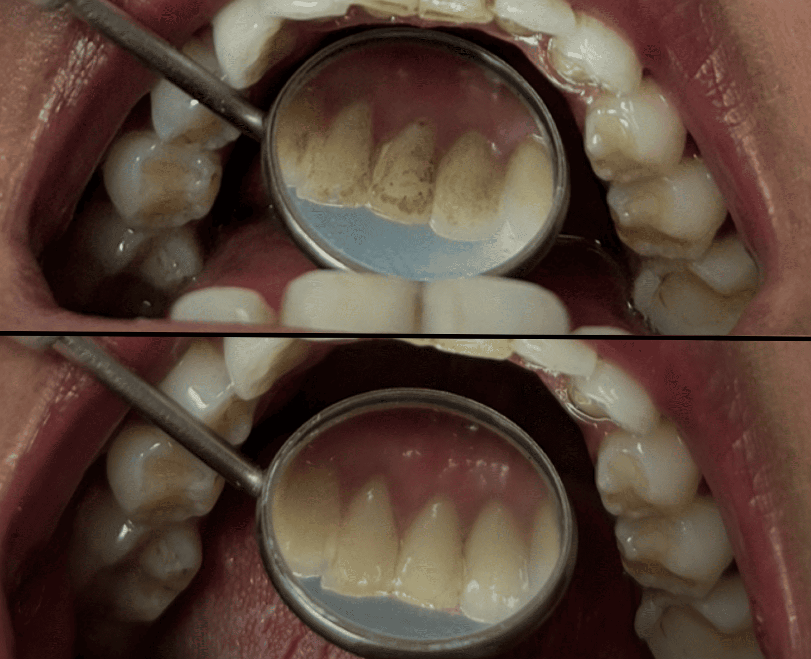 Antes e depois de limpeza dental profissional em Florianópolis