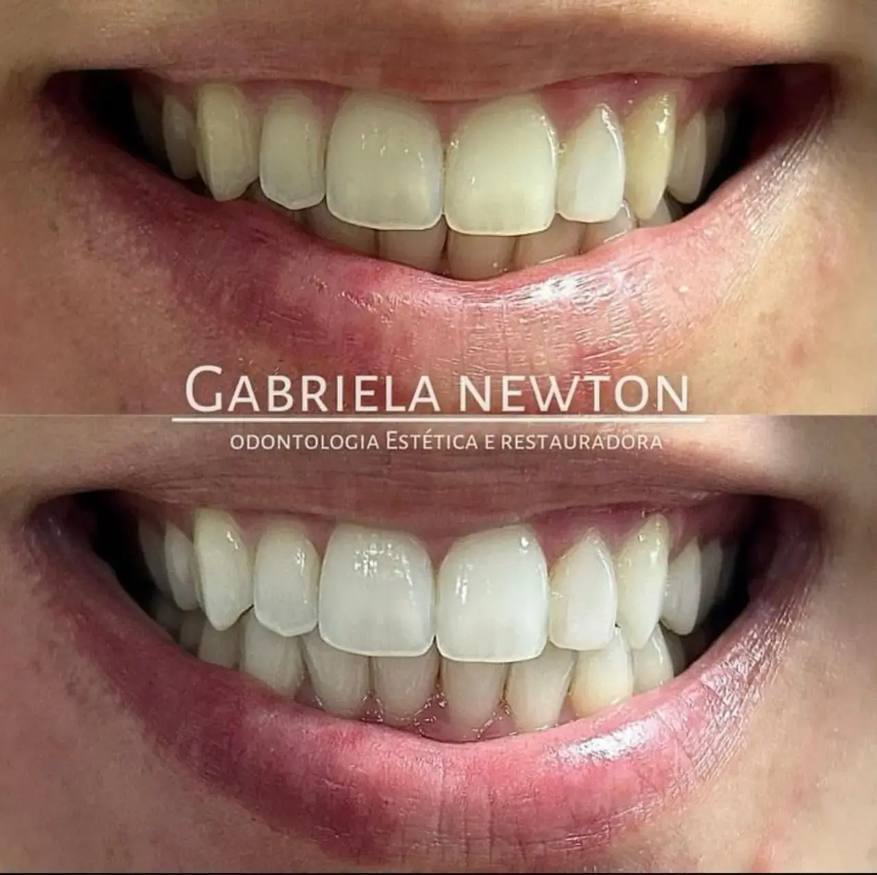 Antes e depois de clareamento dental — Dra. Gabriela Newton