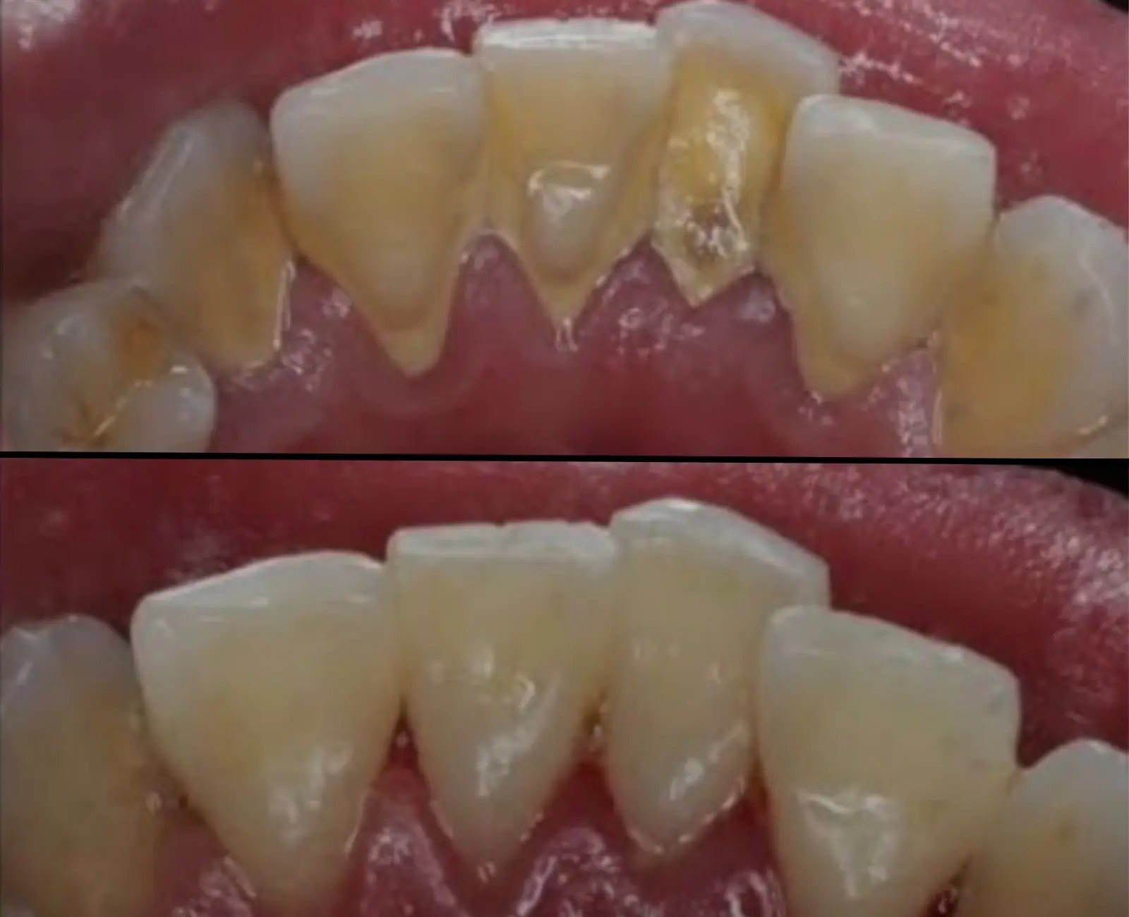 Antes e depois da limpeza e profilaxia — Dra. Gabriela Newton